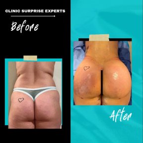 Vorher-nachher-Ergebnis Brazilian Butt Lift bei Surprise Experts Clinic, verbesserte Kontur
