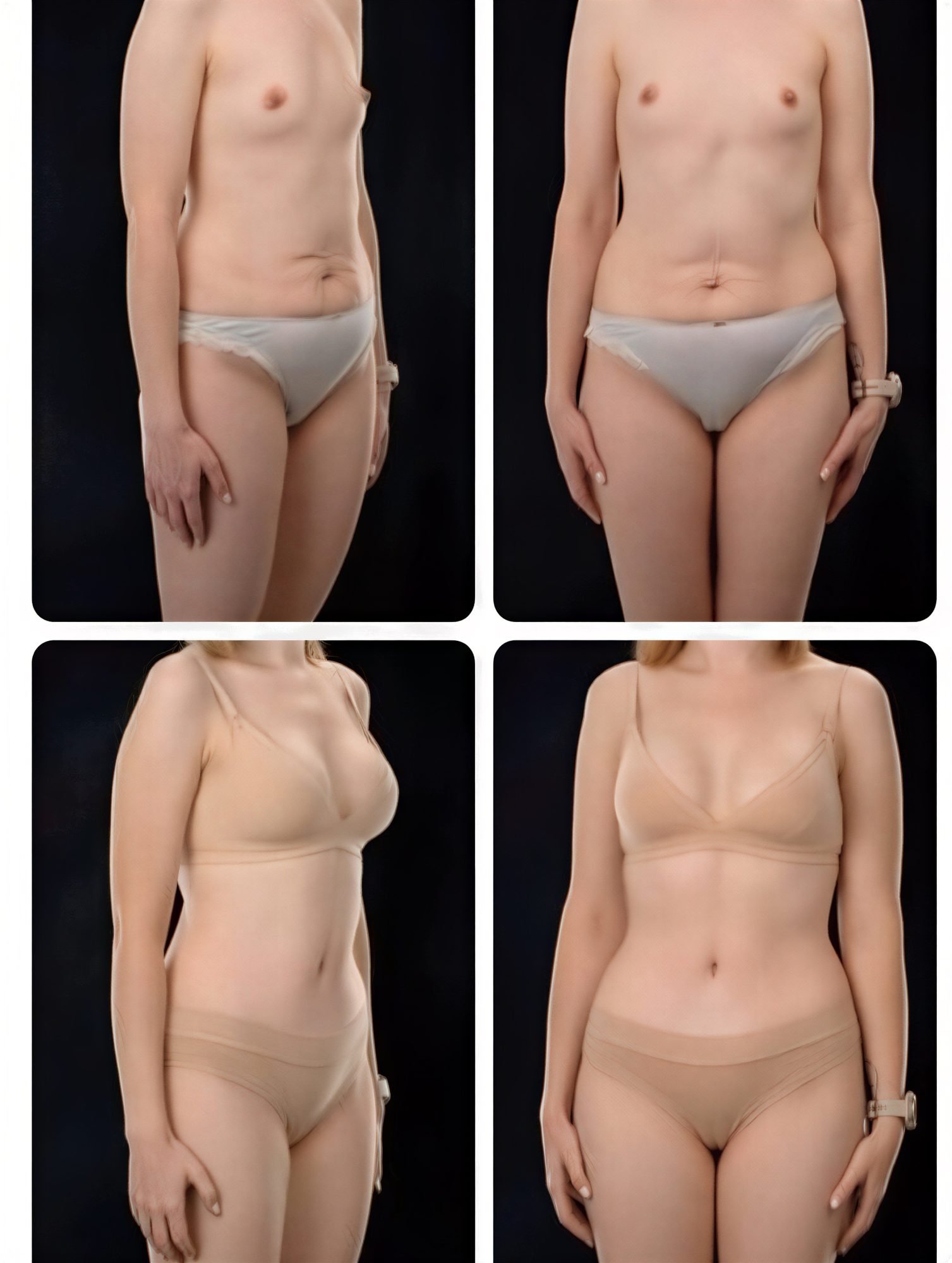 Resultados antes y después de mommy makeover en Yurchenko Plastic Surgery Team, contorno corporal