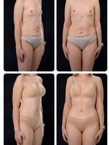Before and after mommy makeover results at Yurchenko Plastic Surgery Team, body contouring