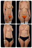 Before and after mommy makeover results at Yurchenko Plastic Surgery Team, body contouring