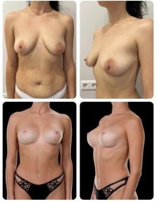 Mommy makeover before and after results at Yurchenko Plastic Surgery Team, breast and body contour