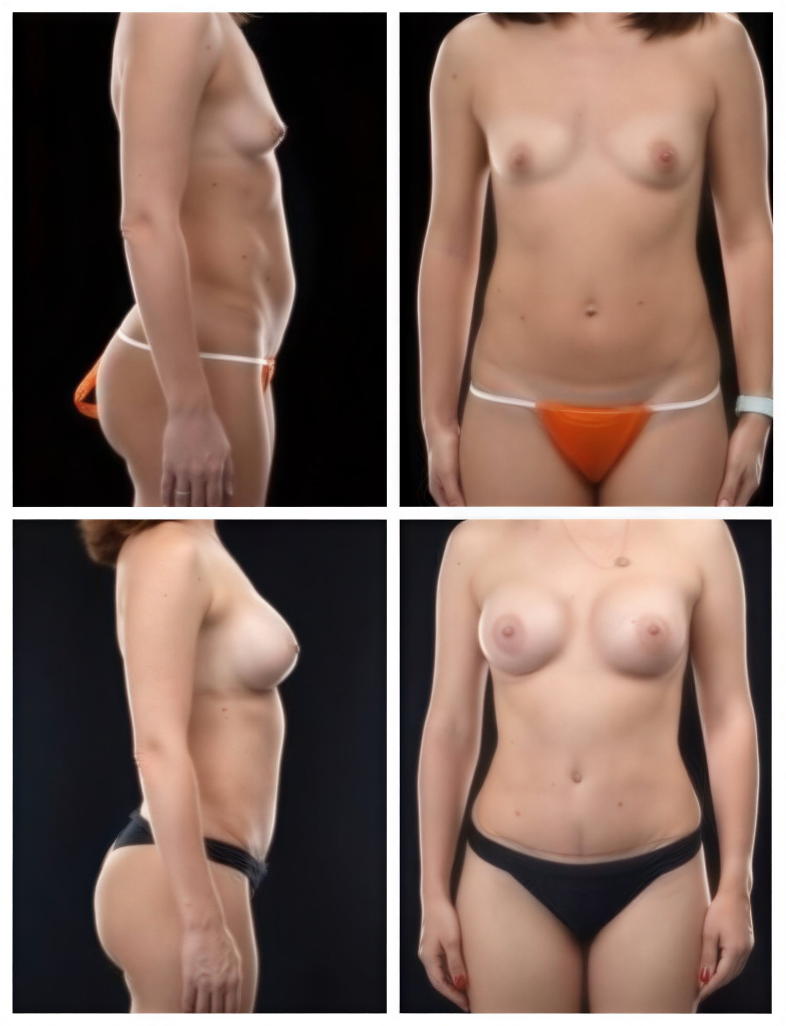 نتائج قبل وبعد عملية تجميل الأم في Yurchenko Plastic Surgery Team، تنسيق الجسم