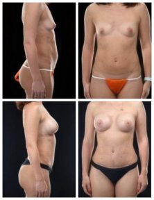 Before and after mommy makeover results at Yurchenko Plastic Surgery Team, body contouring