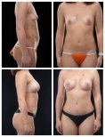 Before and after mommy makeover results at Yurchenko Plastic Surgery Team, body contouring