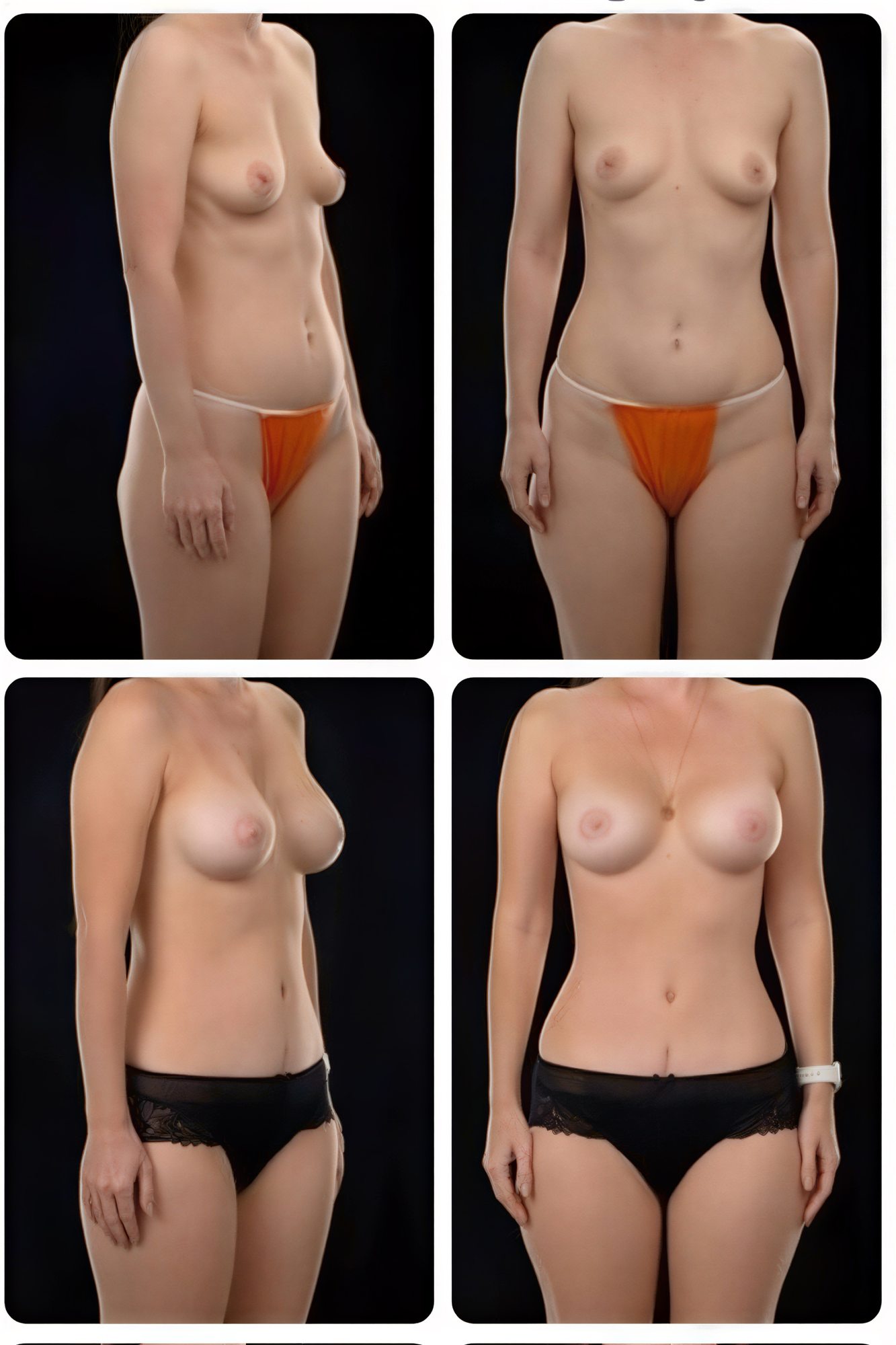 نتائج قبل وبعد عملية تجميل الأم في Yurchenko Plastic Surgery Team، تنسيق القوام