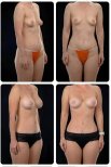 Before and after mommy makeover results at Yurchenko Plastic Surgery Team, body contouring