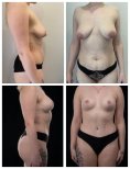 Before and after mommy makeover results at Yurchenko Plastic Surgery Team, body contour improved
