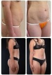 Before and after mommy makeover results at Yurchenko Plastic Surgery Team, body contouring