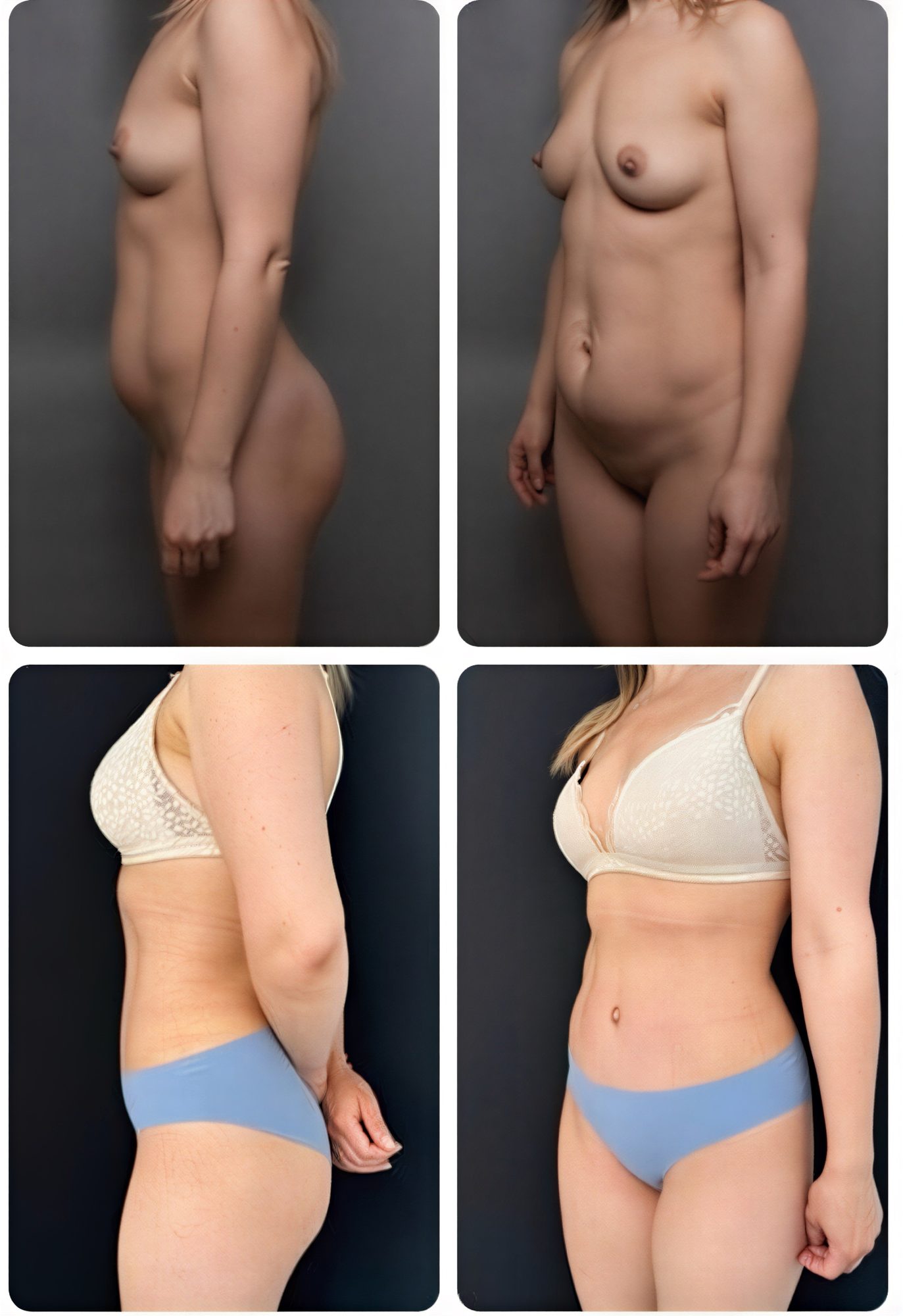 نتائج قبل وبعد عملية مامي ميك أوفر في Yurchenko Plastic Surgery Team، نحت الجسم