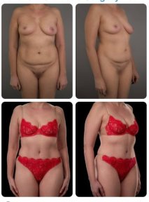 Mommy makeover before and after results at Yurchenko Plastic Surgery Team, body contouring