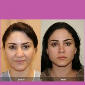 Before and after revision rhinoplasty result at ID Clinic Bangkok, improved nose shape
