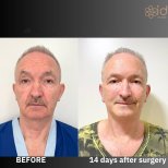 Deep plane facelift before and after results at ID Clinic Bangkok, 14 days post-surgery