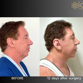 Deep Plane Facelift before and after results at ID Clinic Bangkok, visible facial rejuvenation