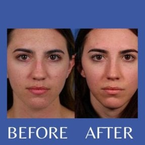 Before and after revision rhinoplasty result at ID Clinic Bangkok, improved nose shape