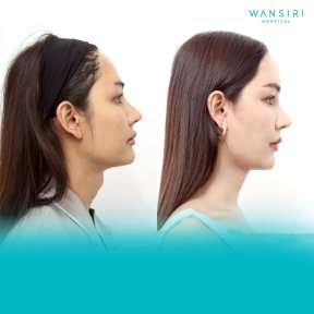 Before and after facial feminization surgery results at Wansiri Hospital, profile transformation