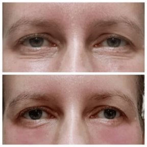 Before and after fillers injection under eyes at Charismma Clinic, reduced dark circles result