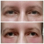 Before and after fillers injection under eyes at Charismma Clinic, reduced dark circles result
