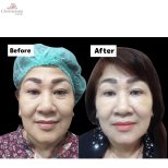 Resultados de blefaroplastia superior e inferior antes y después en Charismma Clinic, mirada rejuvenecida