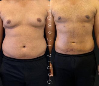 Liposuktion Vorher-Nachher-Ergebnis bei Adem and Havva Medical Center, verbesserte Körperform