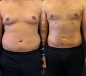 Liposuktion Vorher-Nachher-Ergebnis bei Adem and Havva Medical Center, verbesserte Körperform