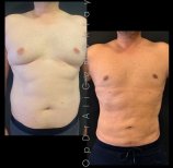 Vorher-nachher-Liposuktionsergebnis bei Adem and Havva Medical Center, verbesserte Körperform