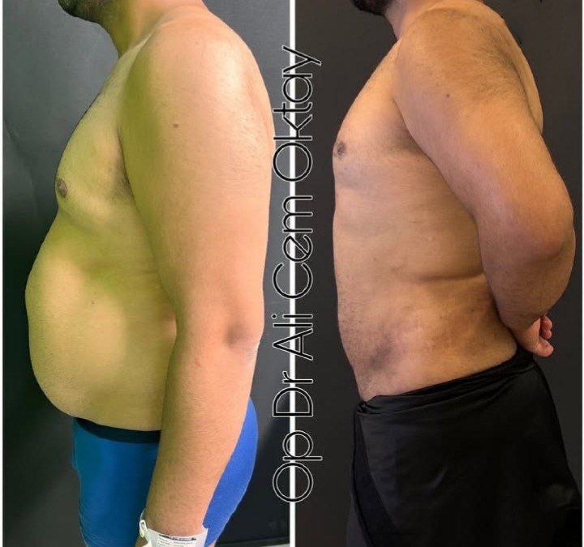 Resultados de liposucción antes y después en Adem and Havva Medical Center, mejor contorno corporal