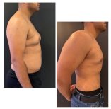 Vorher-nachher-Liposuktionsergebnis bei Adem and Havva Medical Center, verbesserte Körperkontur