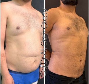 Vorher-nachher-Liposuktionsergebnis bei Adem and Havva Medical Center, verbesserte Bauchkontur