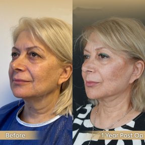 Brow Lift Vorher-Nachher-Ergebnis bei Dr. Safa Manav Clinic, sichtbare Stirnstraffung
