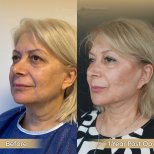 Brow Lift Vorher-Nachher-Ergebnis bei Dr. Safa Manav Clinic, sichtbare Stirnstraffung