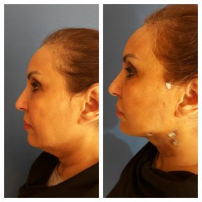 Before and after fillers injection at CE International Hospital, visible jawline contour result