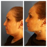Before and after fillers injection at CE International Hospital, visible jawline contour result