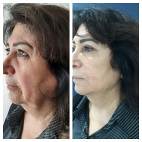 Before and after fillers injection result at CE International Hospital, facial rejuvenation visible