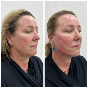 Before and after fillers injection at CE International Hospital, facial volume and contour results