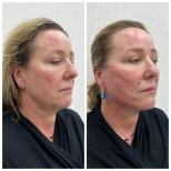 Before and after fillers injection at CE International Hospital, facial volume and contour results
