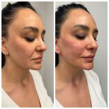 Before and after fillers injection result at CE International Hospital, enhanced facial volume
