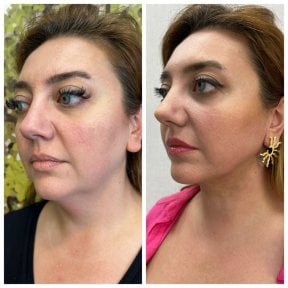 Before and after fillers injection result at CE International Hospital, enhanced facial contours