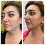 Before and after fillers injection result at CE International Hospital, enhanced facial contours