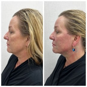 Before and after fillers injection result at CE International Hospital, facial contour enhancement