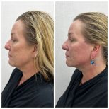Before and after fillers injection result at CE International Hospital, facial contour enhancement
