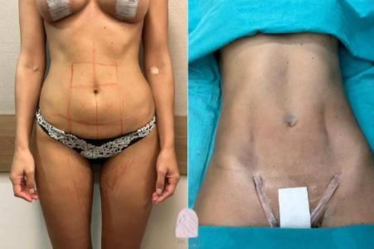 Efekty plastyki brzucha przed i po w Dr. MED – poprawa konturu brzucha