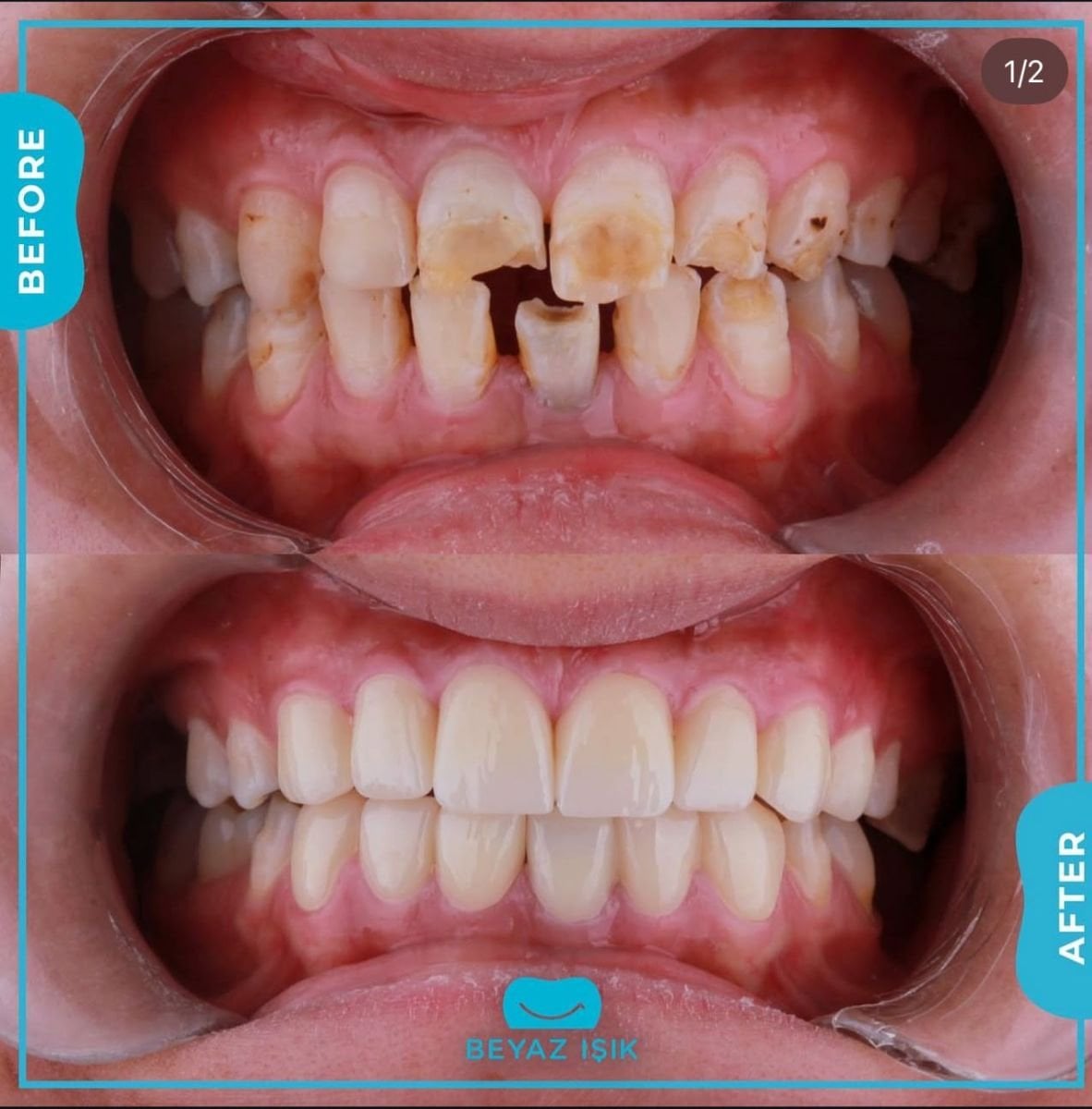 نتائج قبل وبعد ترابط الأسنان في Adem and Havva Medical Center، ابتسامة محسنة