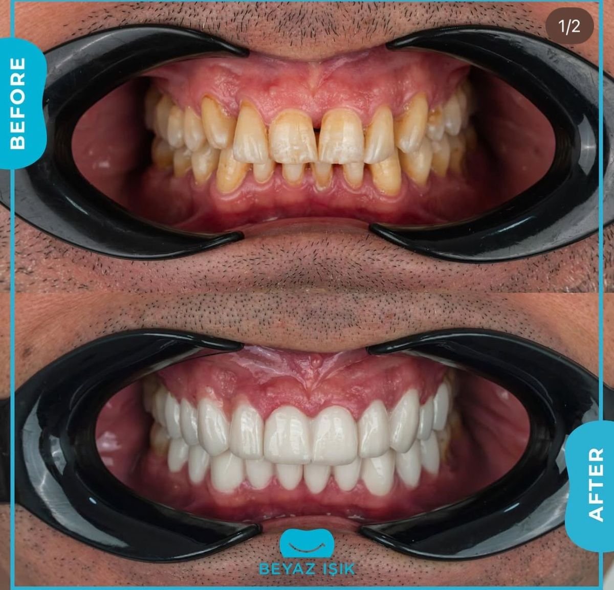 Resultados de bonding dental antes y después en Adem and Havva Medical Center, sonrisa mejorada
