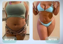 Vorher-nachher-Ergebnisse Bauchdeckenstraffung bei Adem and Havva Medical Center, sichtbare Kontur