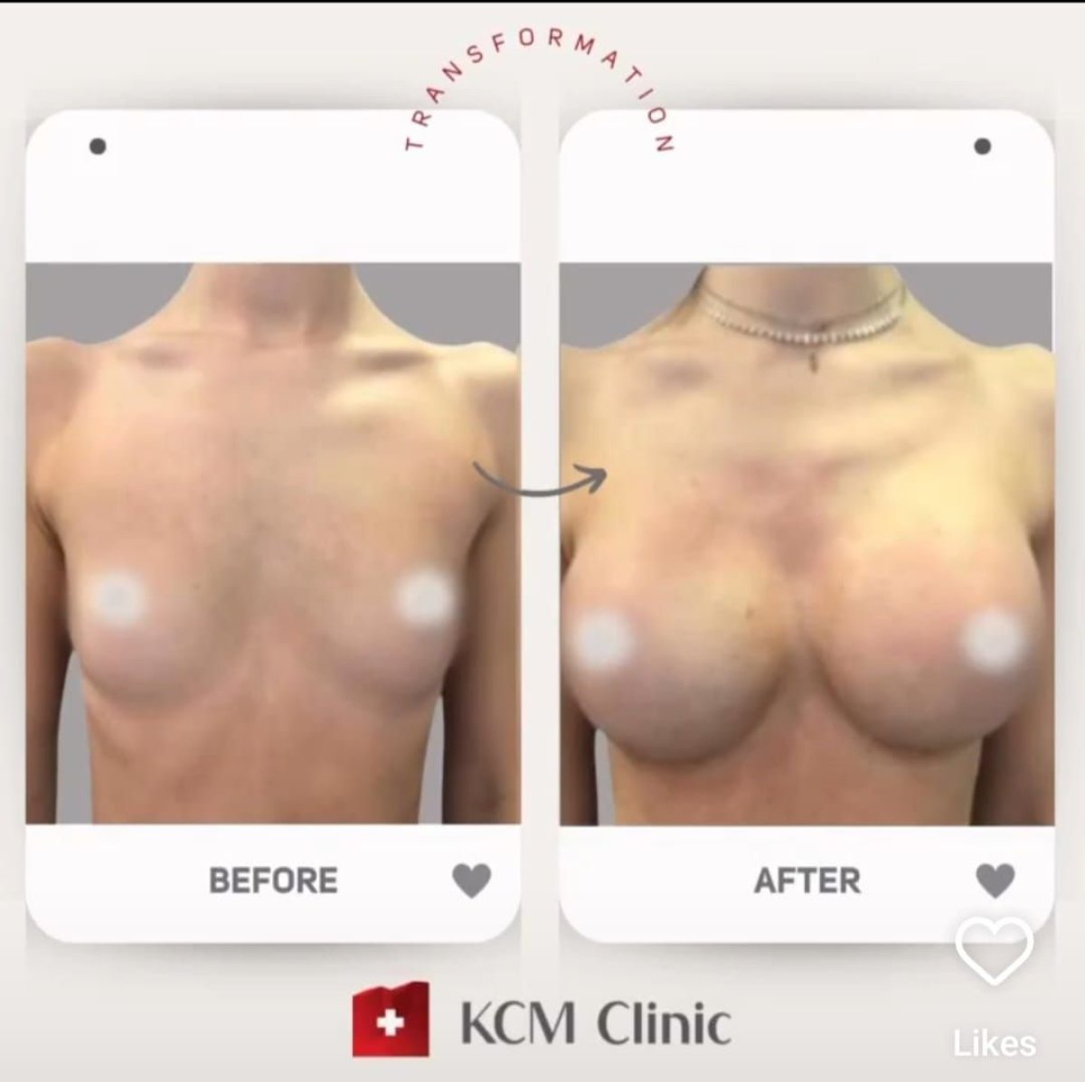 Before and after breast lift results at KCM Clinic – improved breast shape and contour