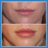 Before and after lip lift results at ID Clinic Bangkok, enhanced upper lip contour visible