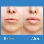 Before and after lip lift results at ID Clinic Bangkok, enhanced upper lip contour and volume