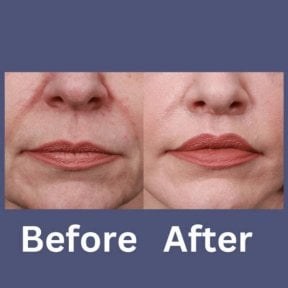 Before and after lip lift results at ID Clinic Bangkok, enhanced lip contour and youthful look