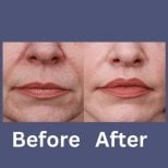 Before and after lip lift results at ID Clinic Bangkok, enhanced lip contour and youthful look