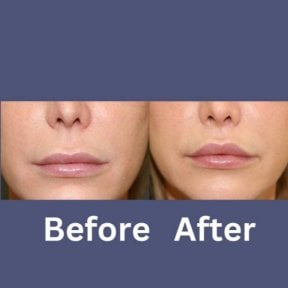 Before and after lip lift results at ID Clinic Bangkok, enhanced upper lip contour